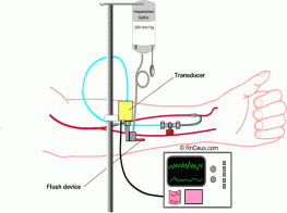 Intra Arterial Blood Pressure